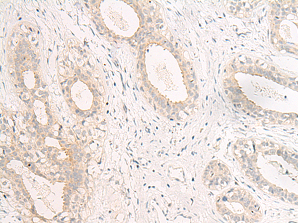 Immunohistochemistry of paraffin-embedded Human breast cancer tissue  using GPR157 Polyclonal Antibody at dilution of 1:60(×200)