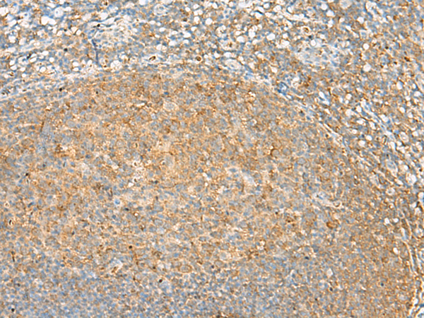 Immunohistochemistry of paraffin-embedded Human tonsil tissue  using GRHPR Polyclonal Antibody at dilution of 1:30(×200)