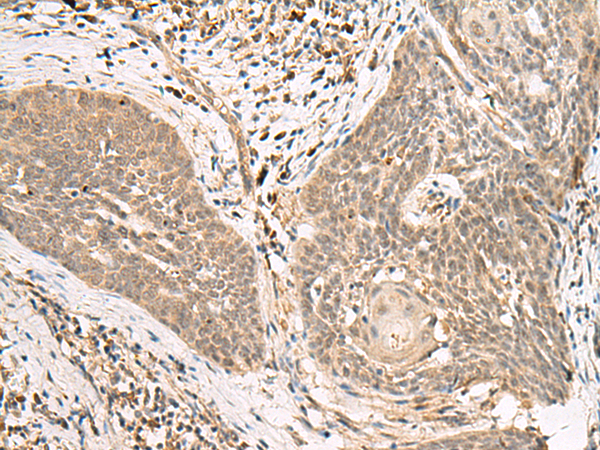 Immunohistochemistry of paraffin-embedded Human esophagus cancer tissue  using LGALSL Polyclonal Antibody at dilution of 1:25(×200)