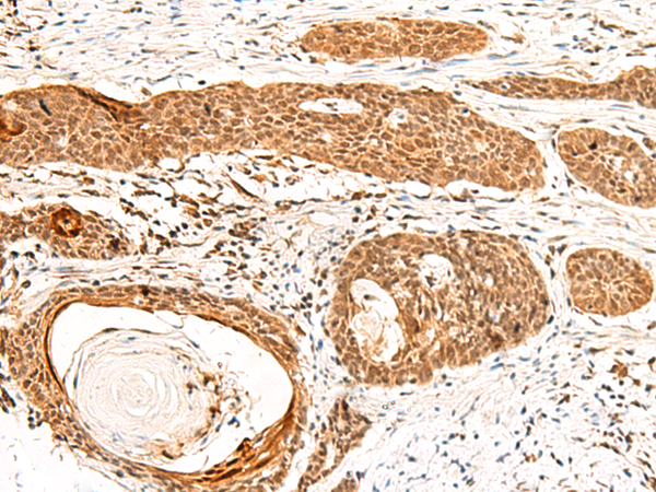 Immunohistochemistry of paraffin-embedded Human esophagus cancer tissue  using GTF3A Polyclonal Antibody at dilution of 1:60(×200)
