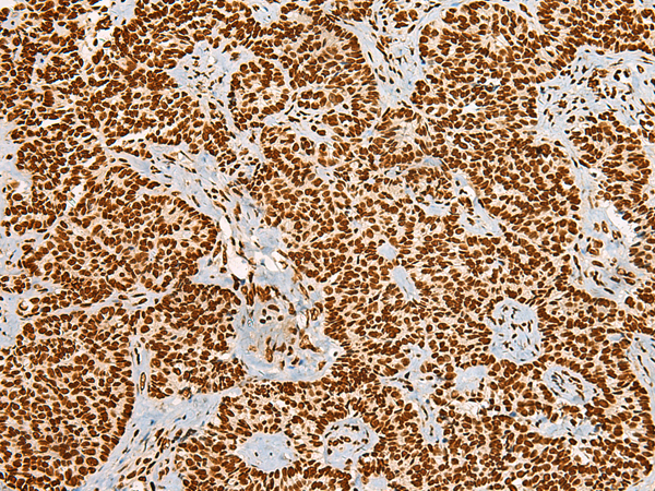 Immunohistochemistry of paraffin-embedded Human ovarian cancer tissue  using HABP4 Polyclonal Antibody at dilution of 1:55(×200)