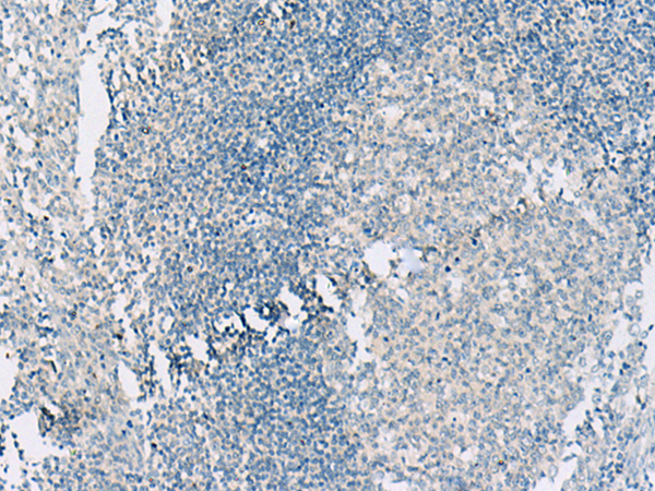 Immunohistochemistry of paraffin-embedded Human tonsil tissue  using HASPIN Polyclonal Antibody at dilution of 1:55(×200)