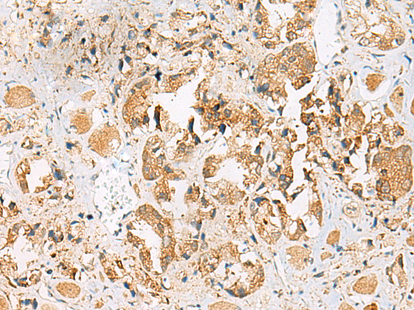 Immunohistochemistry of paraffin-embedded Human prost ate cancer tissue  using HEBP1 Polyclonal Antibody at dilution of 1:40(×200)