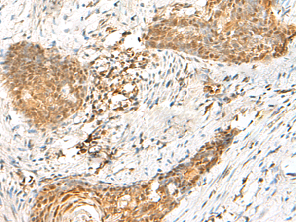 Immunohistochemistry of paraffin-embedded Human esophagus cancer tissue  using HMBOX1 Polyclonal Antibody at dilution of 1:60(×200)