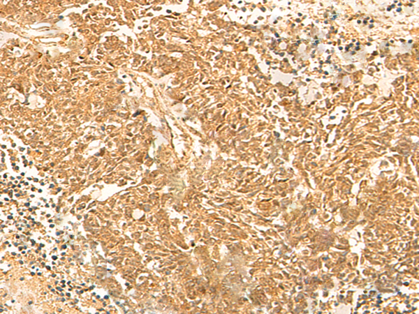 Immunohistochemistry of paraffin-embedded Human lung cancer tissue  using KRT76 Polyclonal Antibody at dilution of 1:30(×200)