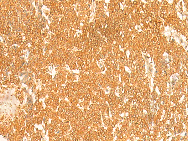 Immunohistochemistry of paraffin-embedded Human ovarian cancer tissue  using KRT76 Polyclonal Antibody at dilution of 1:30(×200)