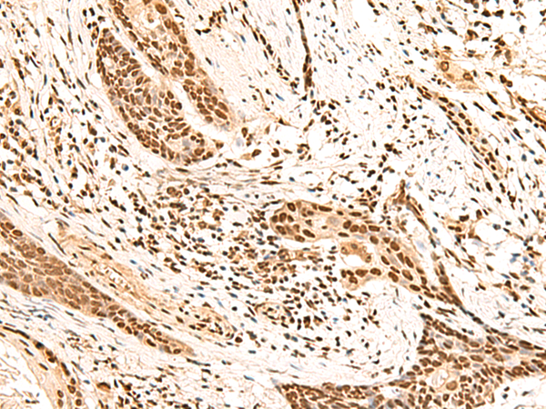 Immunohistochemistry of paraffin-embedded Human esophagus cancer tissue  using HOXC13 Polyclonal Antibody at dilution of 1:60(×200)
