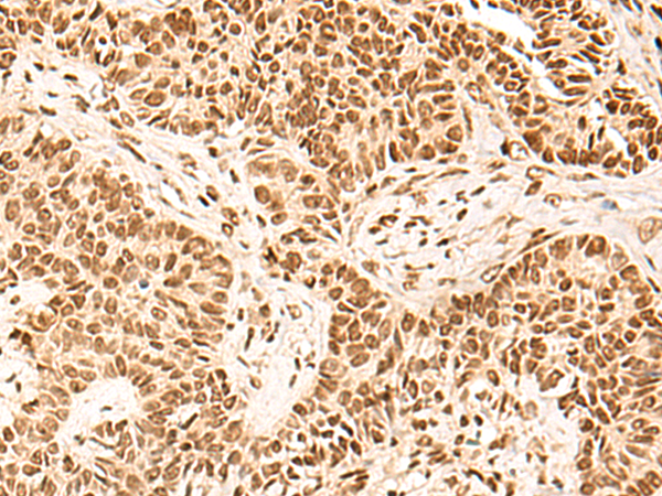 Immunohistochemistry of paraffin-embedded Human ovarian cancer tissue  using HOXC13 Polyclonal Antibody at dilution of 1:60(×200)
