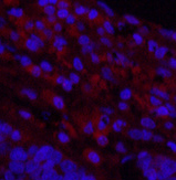 Immunofluorescence analysis of Human lung cancer tissue using Cleaved-NOTCH1 (V1754) Polyclonal Antibody at dilution of 1:200.