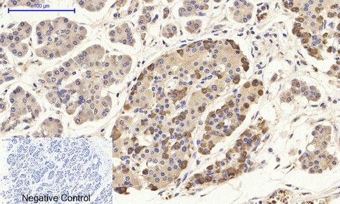 Immunohistochemistry of paraffin-embedded Human stomach cancer tissue using CD284 Polyclonal Antibody at dilution of 1:200.