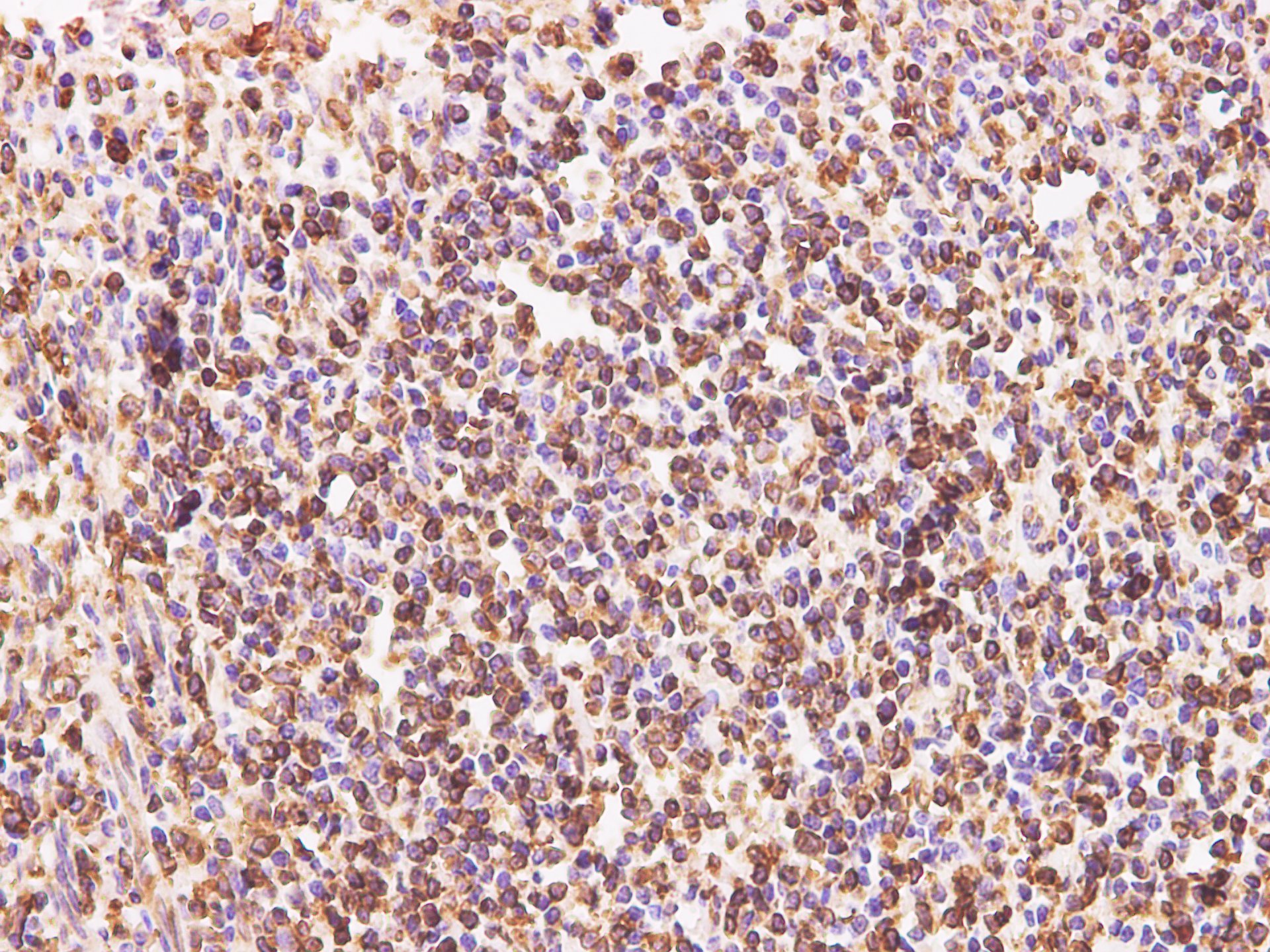 Immunohistochemistry of paraffin-embedded Human tonsil  using CD74 Polyclonal Antibody at dilution of 1:200