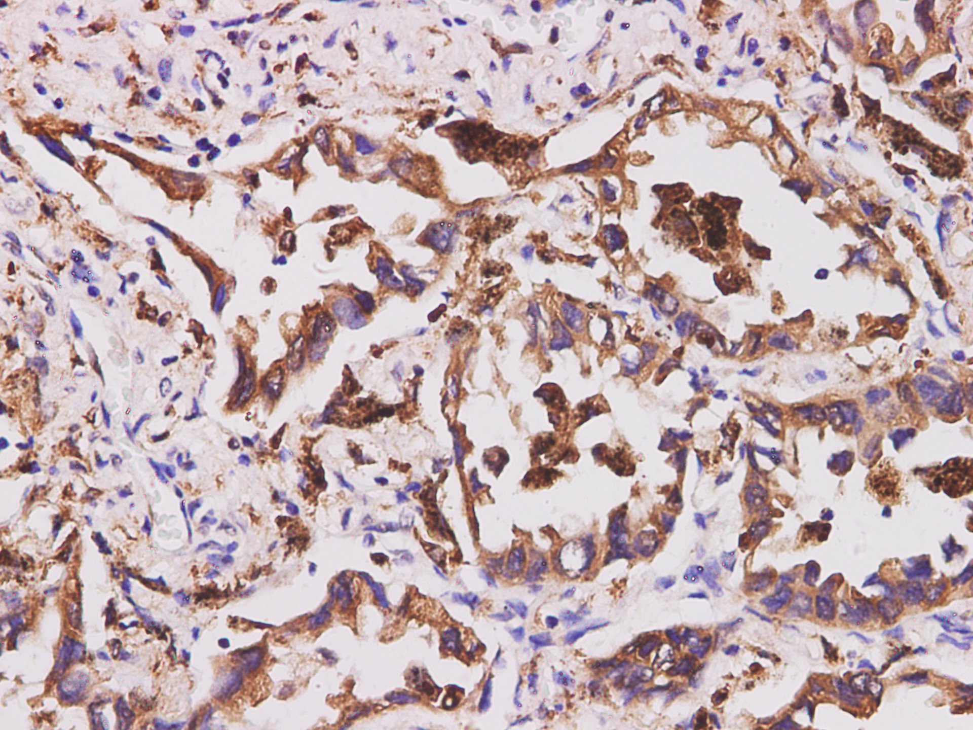 Immunohistochemistry of paraffin-embedded Human lung cancer  using CD74 Polyclonal Antibody at dilution of 1:200