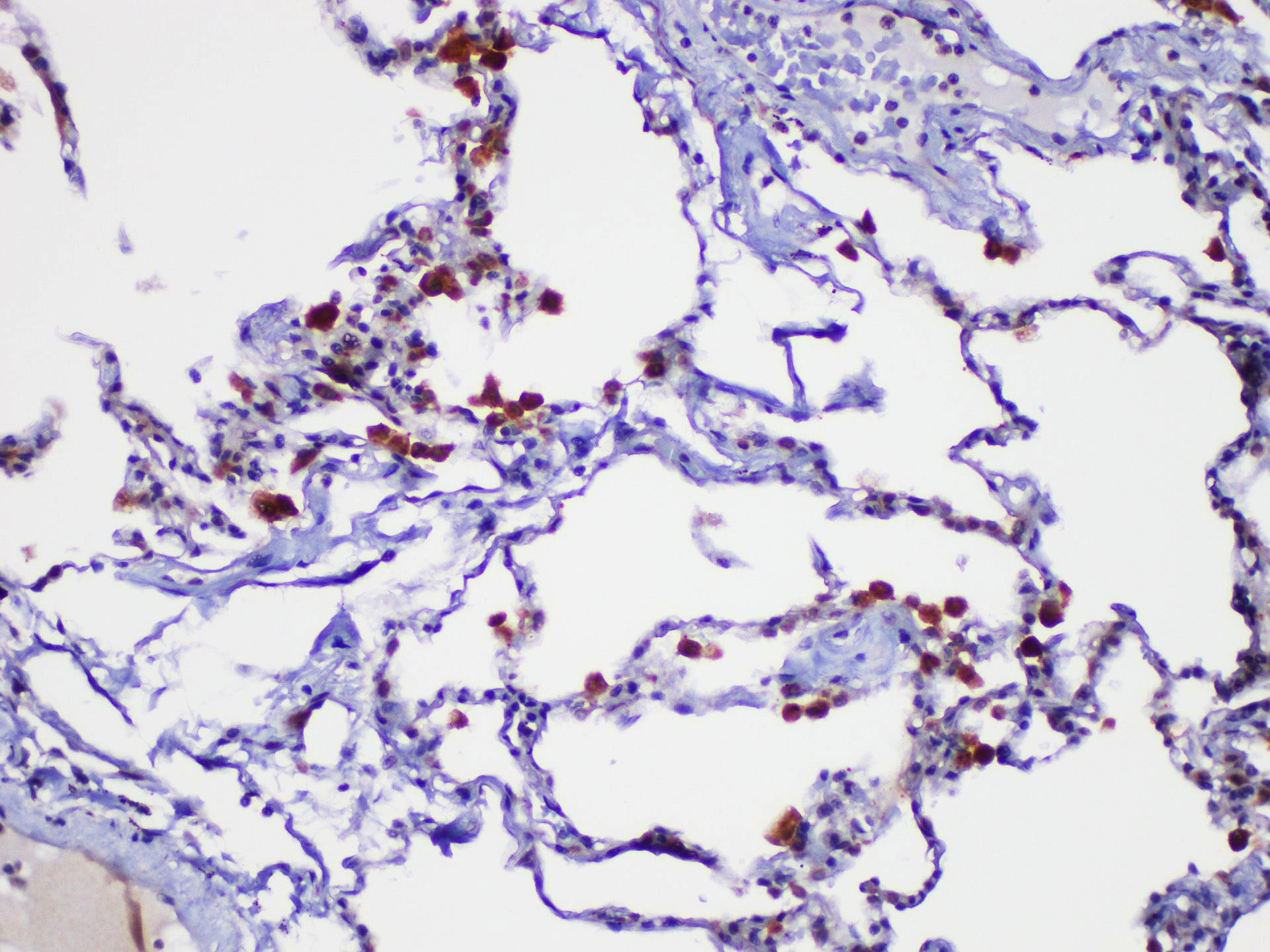 Immunohistochemistry of paraffin-embedded Human lung using LGALS3 Polycloanl Antibody at dilution of 1:200