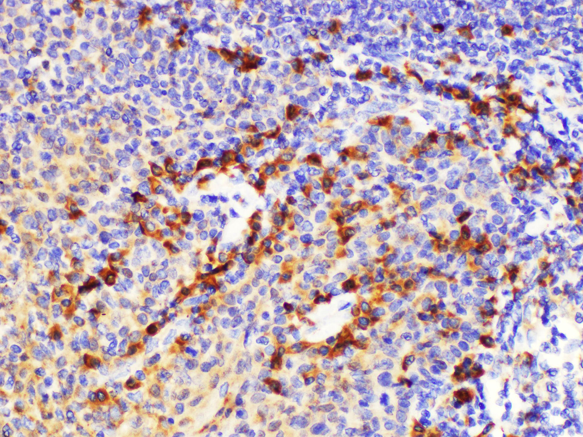 Immunohistochemistry of paraffin-embedded Human tonsil using S100a8 Polycloanl Antibody at dilution of 1:200