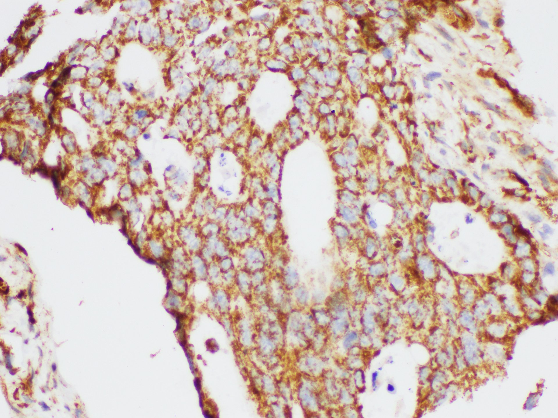 Immunohistochemistry of paraffin-embedded Human colon cancer using KLK6 Ployclonal Antibody at dilution of 1:200.