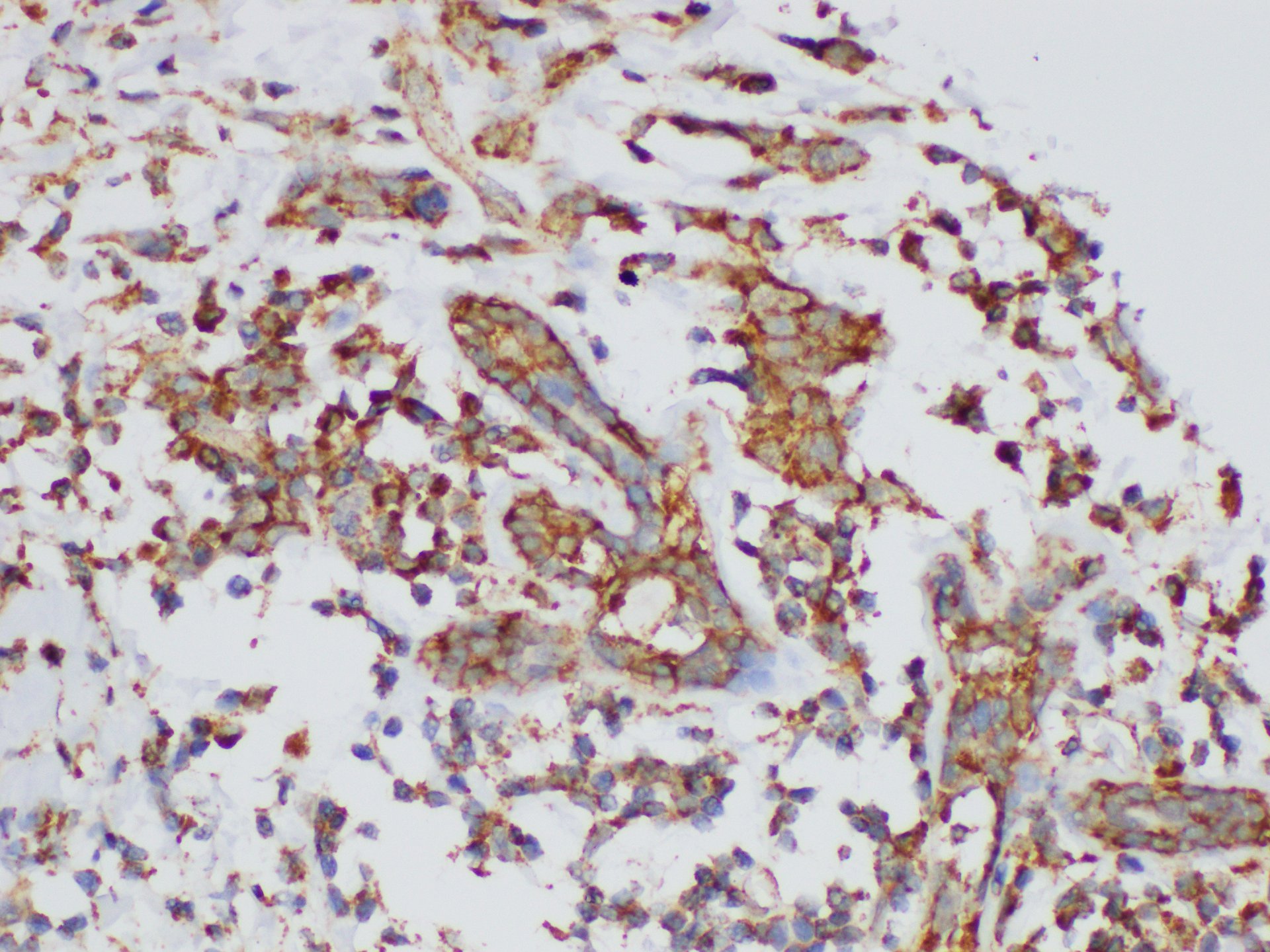 Immunohistochemistry of paraffin-embedded Human breast cancer using KLK6 Ployclonal Antibody at dilution of 1:200.