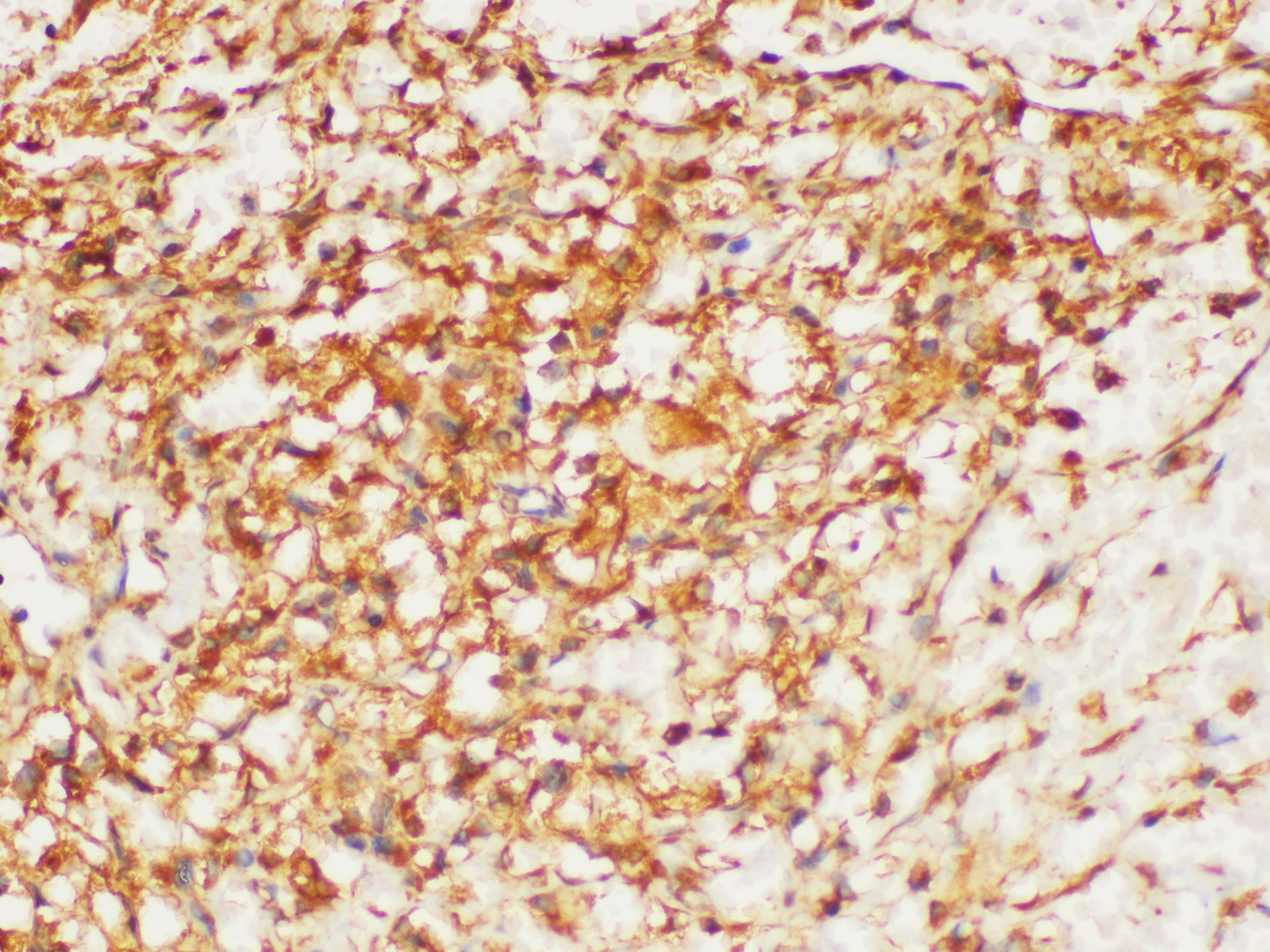 Immunohistochemistry of paraffin-embedded Human kidney cancer using HRAS Polycloanl Antibody at dilution of 1:200