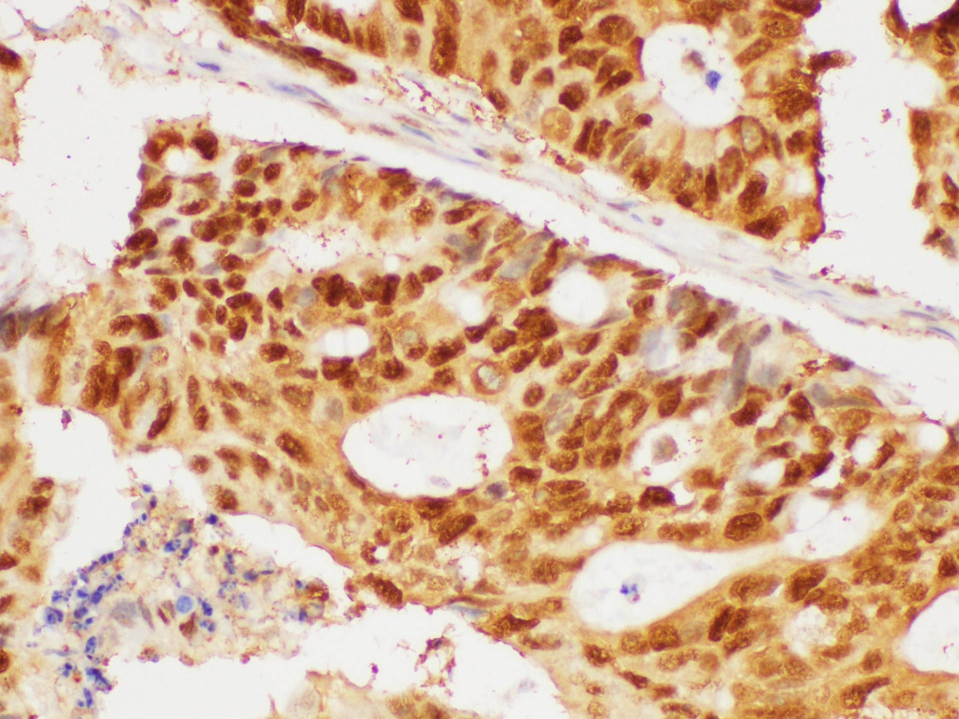 Immunohistochemistry of paraffin-embedded Human colon cancer using PCNA Polycloanl Antibody at dilution of 1:50