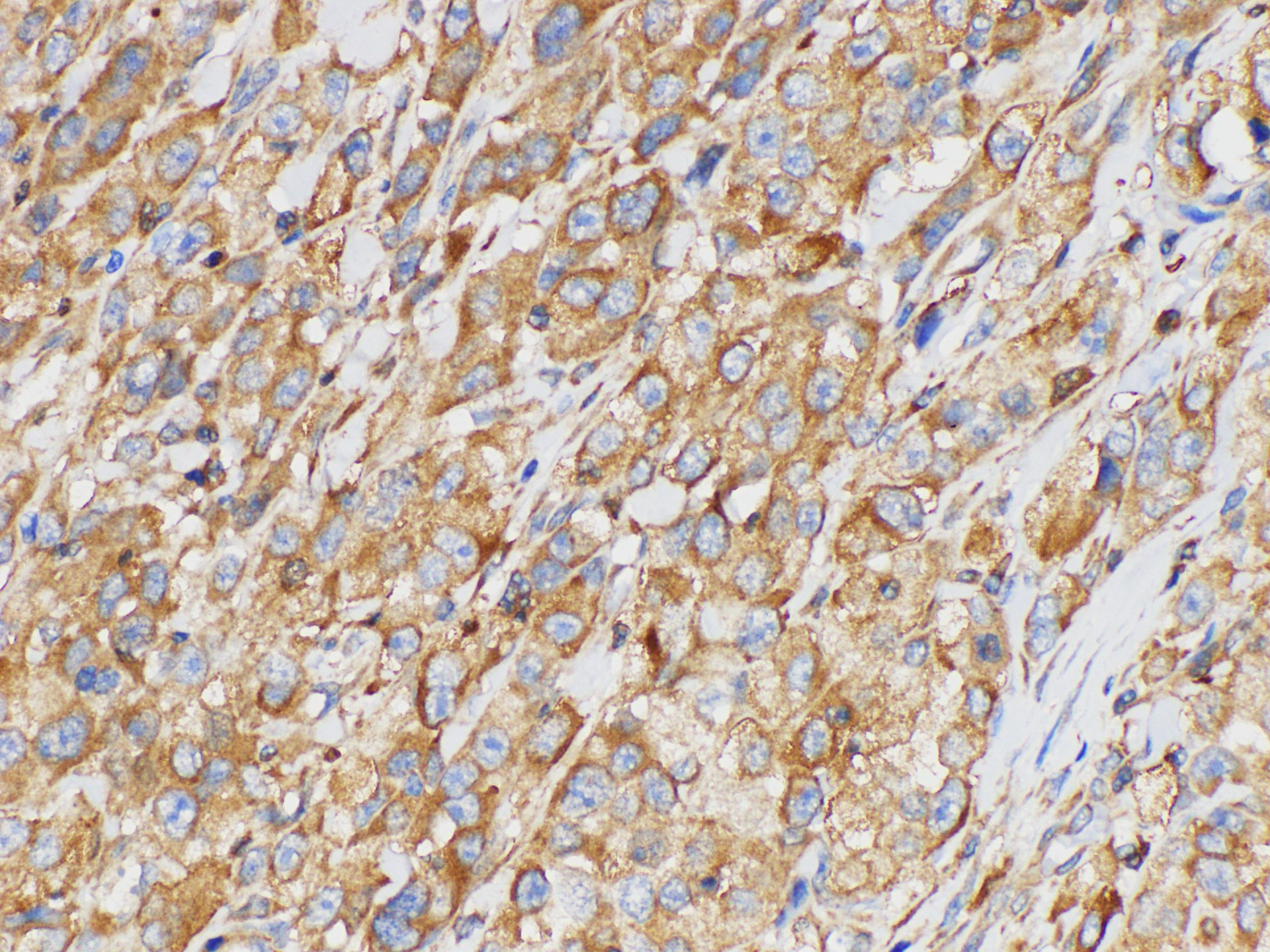 Immunohistochemistry of paraffin-embedded Human esophageal squamous carcinomas using SERPINB2 Polycloanl Antibody at dilution of 1:200