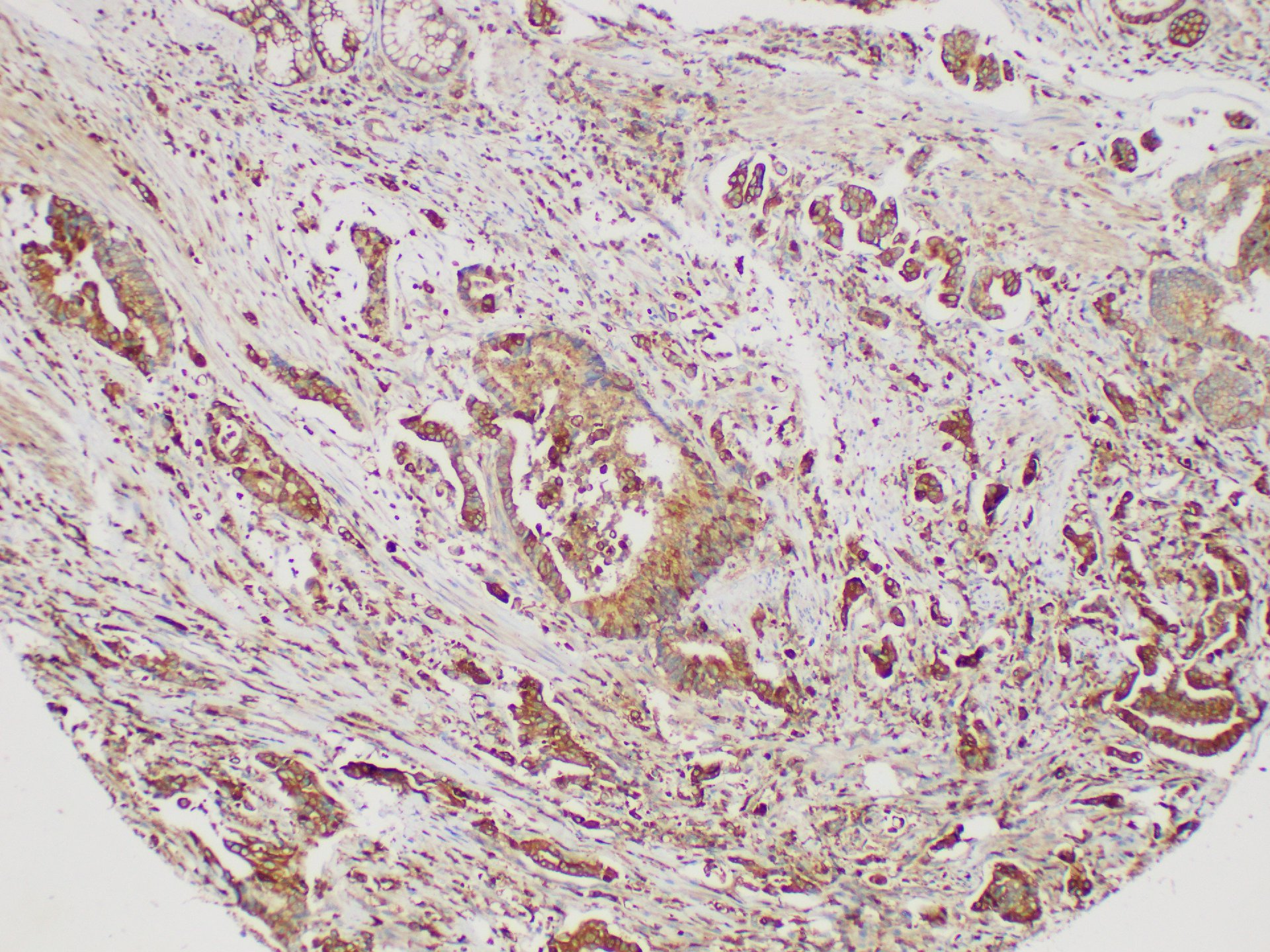 Immunohistochemistry of paraffin-embedded Human duodenal carcinoma using S100A4 Polycloanl Antibody at dilution of 1:200