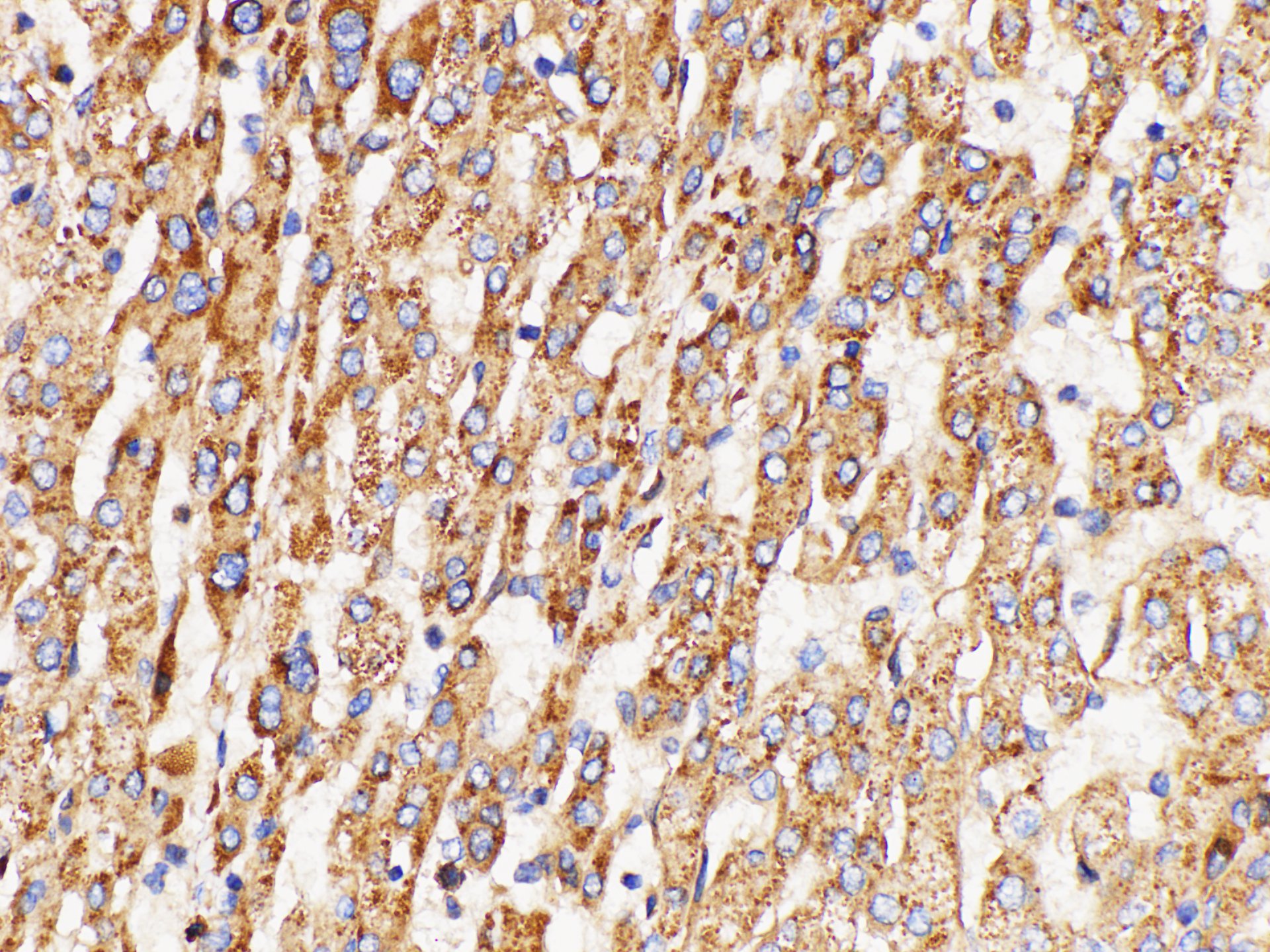 Immunohistochemistry of paraffin-embedded Human liver cancer using GPNMB Polycloanl Antibody at dilution of 1:200