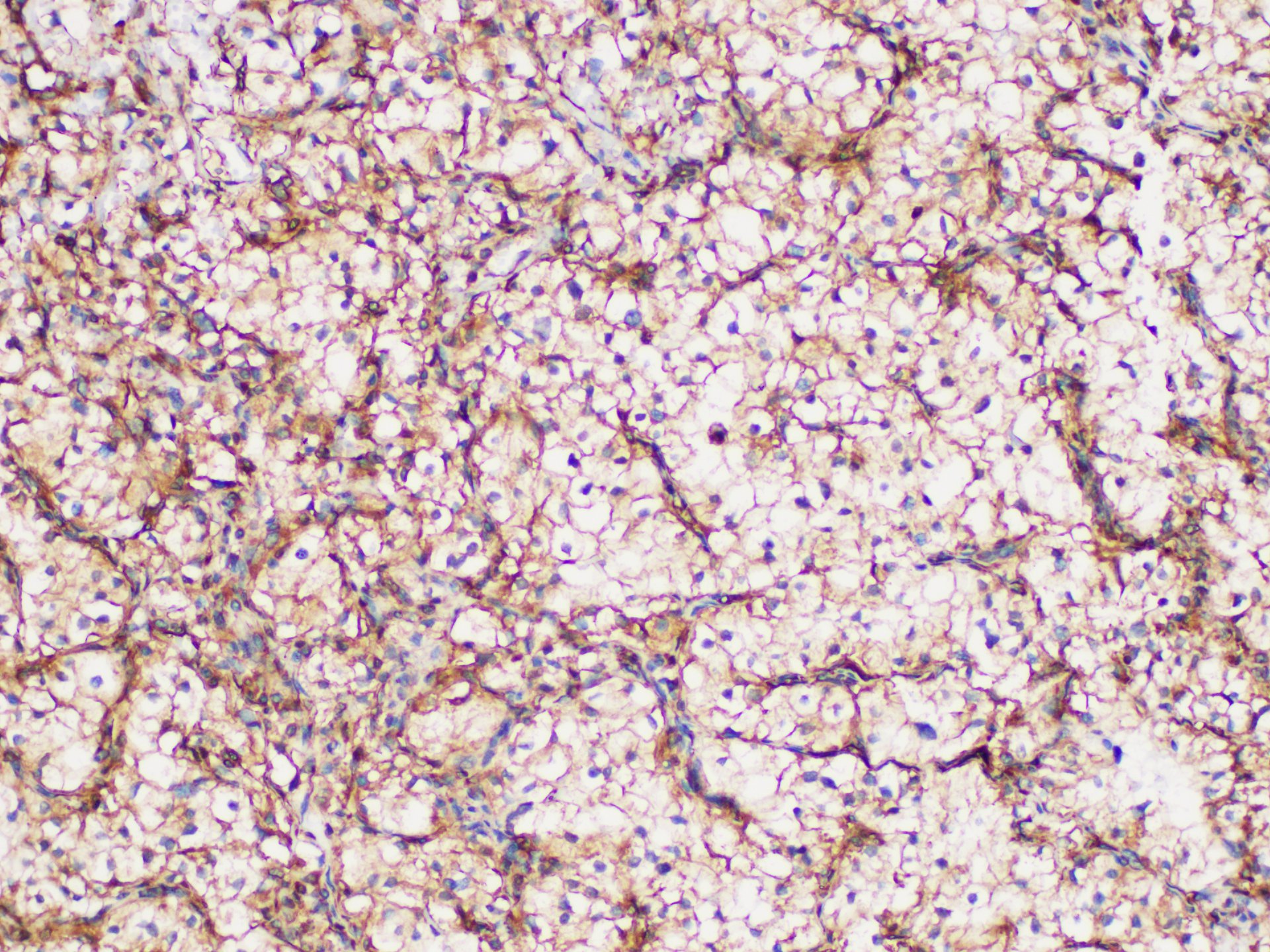 Immunohistochemistry of paraffin-embedded Human renal clear cell carcinoma using GPNMB Polycloanl Antibody at dilution of 1:200