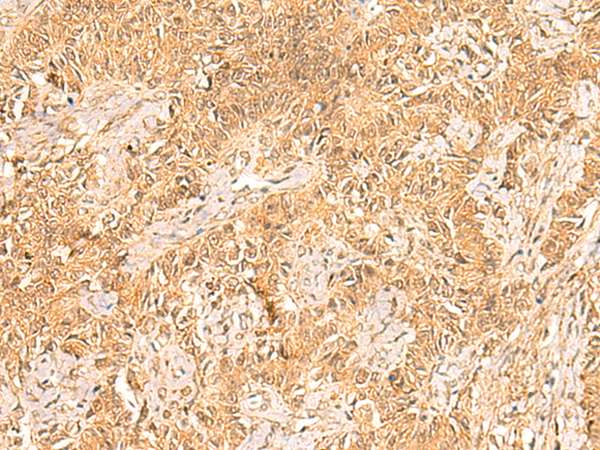 Immunohistochemistry of paraffin-embedded Human ovarian cancer tissue  using TRMT112 Polyclonal Antibody at dilution of 1:30(×200)