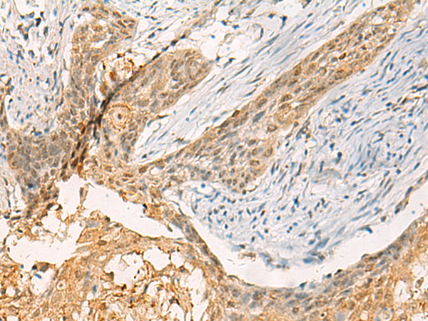 Immunohistochemistry of paraffin-embedded Human esophagus cancer tissue  using TBCK Polyclonal Antibody at dilution of 1:40(×200)