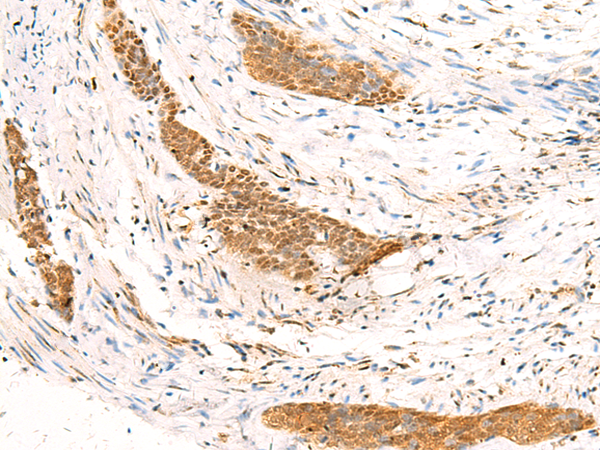 Immunohistochemistry of paraffin-embedded Human esophagus cancer tissue  using HTT Polyclonal Antibody at dilution of 1:30(×200)