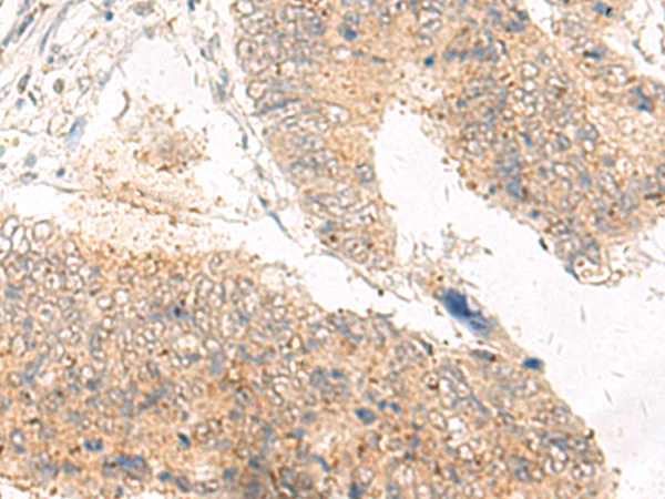 Immunohistochemistry of paraffin-embedded Human tonsil tissue  using IDUA Polyclonal Antibody at dilution of 1:30(×200)