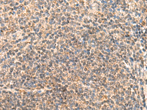 Immunohistochemistry of paraffin-embedded Human colorectal cancer tissue  using IDUA Polyclonal Antibody at dilution of 1:30(×200)
