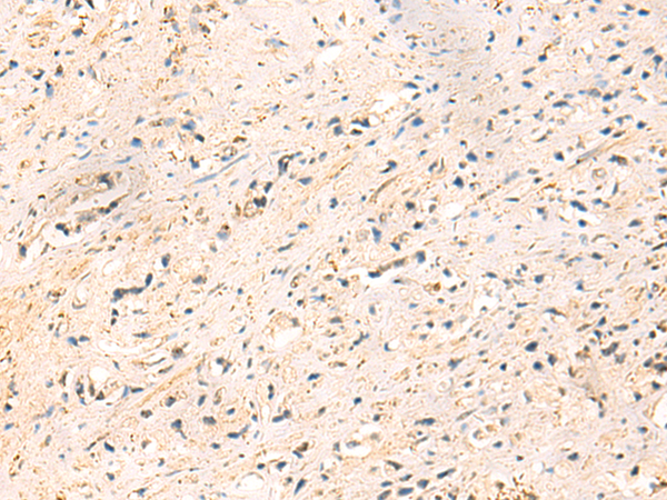 Immunohistochemistry of paraffin-embedded Human prost at e cancer tissue  using IP6K3 Polyclonal Antibody at dilution of 1:50(×200)