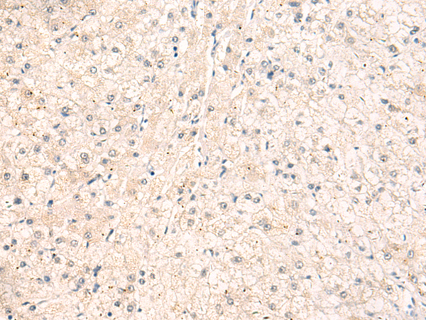 Immunohistochemistry of paraffin-embedded Human liver cancer tissue  using ELP1 Polyclonal Antibody at dilution of 1:30(×200)