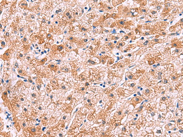 Immunohistochemistry of paraffin-embedded Human liver cancer tissue  using IL4R Polyclonal Antibody at dilution of 1:45(×200)