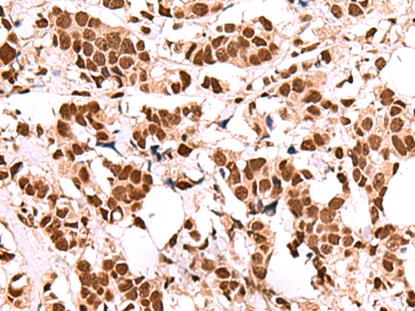 Immunohistochemistry of paraffin-embedded Human breast cancer tissue  using FOXK2 Polyclonal Antibody at dilution of 1:60(×200)