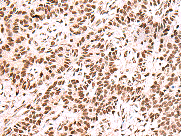 Immunohistochemistry of paraffin-embedded Human ovarian cancer tissue  using FOXK2 Polyclonal Antibody at dilution of 1:60(×200)