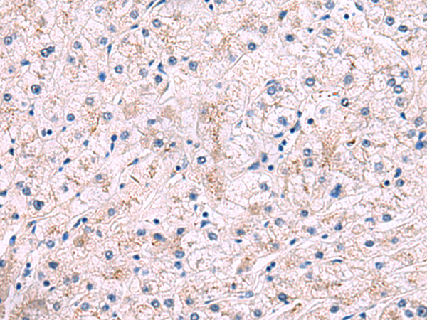 Immunohistochemistry of paraffin-embedded Human liver cancer tissue  using IP6K2 Polyclonal Antibody at dilution of 1:50(×200)