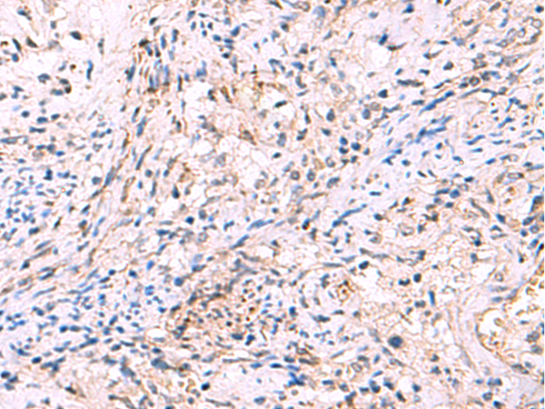 Immunohistochemistry of paraffin-embedded Human cervical cancer tissue  using INPP5B Polyclonal Antibody at dilution of 1:40(×200)