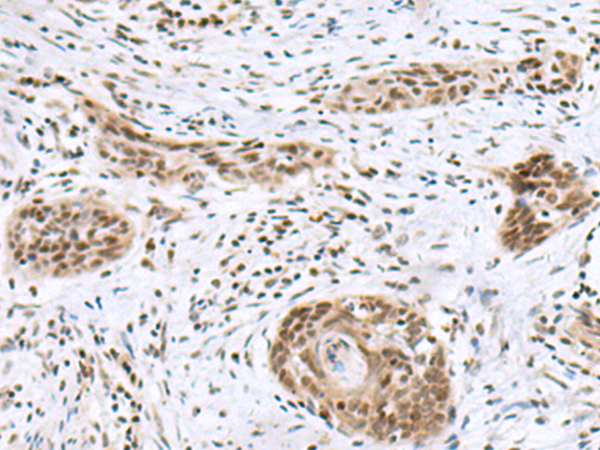 Immunohistochemistry of paraffin-embedded Human esophagus cancer tissue  using INSM1 Polyclonal Antibody at dilution of 1:50(×200)