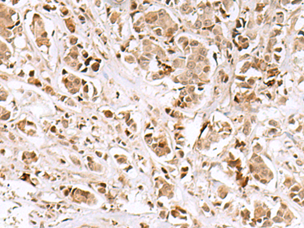 Immunohistochemistry of paraffin-embedded Human breast cancer tissue  using INSM1 Polyclonal Antibody at dilution of 1:50(×200)