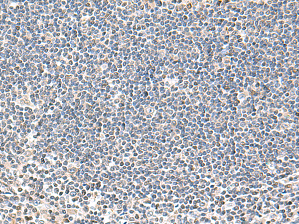 Immunohistochemistry of paraffin-embedded Human tonsil tissue  using IFNA2 Polyclonal Antibody at dilution of 1:40(×200)
