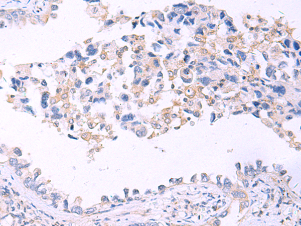 Immunohistochemistry of paraffin-embedded Human lung cancer tissue  using GRIA2 Polyclonal Antibody at dilution of 1:40(×200)