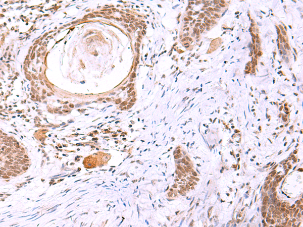 Immunohistochemistry of paraffin-embedded Human esophagus cancer tissue  using ITPKC Polyclonal Antibody at dilution of 1:30(×200)