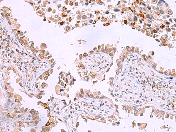 Immunohistochemistry of paraffin-embedded Human lung cancer tissue  using ITPKC Polyclonal Antibody at dilution of 1:30(×200)