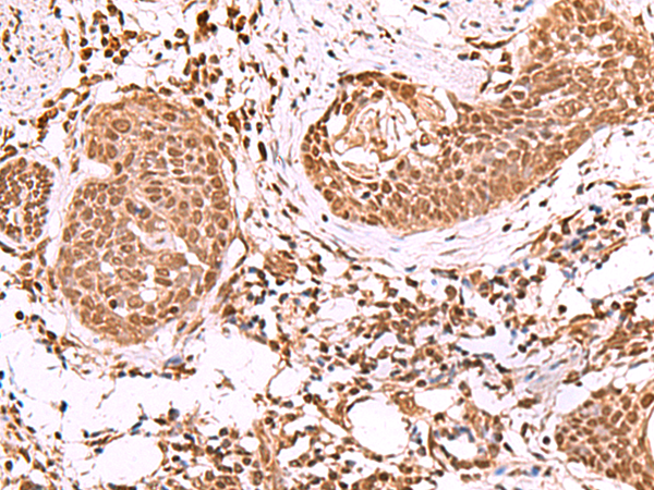 Immunohistochemistry of paraffin-embedded Human esophagus cancer tissue  using IP6K1 Polyclonal Antibody at dilution of 1:55(×200)