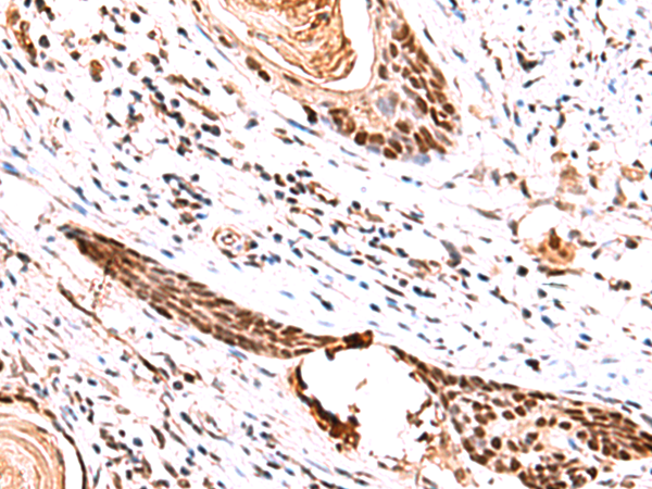 Immunohistochemistry of paraffin-embedded Human esophagus cancer tissue  using IRF2BP1 Polyclonal Antibody at dilution of 1:30(×200)
