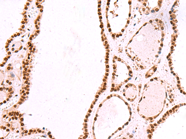 Immunohistochemistry of paraffin-embedded Human thyroid cancer tissue  using IRF2BP1 Polyclonal Antibody at dilution of 1:30(×200)