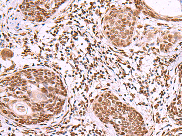 Immunohistochemistry of paraffin-embedded Human esophagus cancer tissue  using IRX1 Polyclonal Antibody at dilution of 1:40(×200)