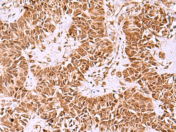 Immunohistochemistry of paraffin-embedded Human ovarian cancer tissue  using IRX1 Polyclonal Antibody at dilution of 1:40(×200)