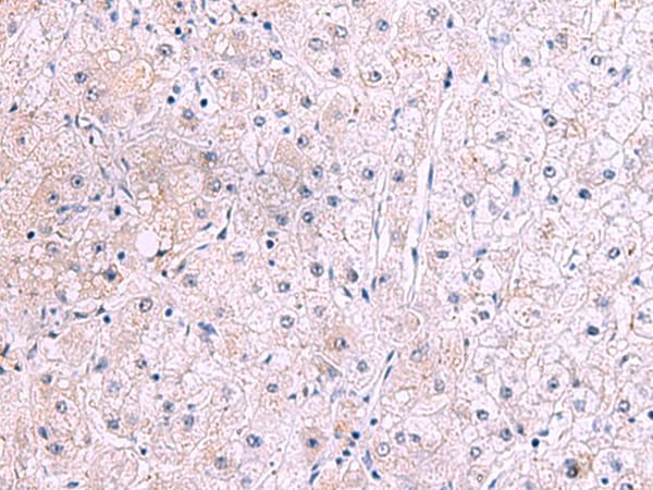 Immunohistochemistry of paraffin-embedded Human liver cancer tissue  using IRX2 Polyclonal Antibody at dilution of 1:45(×200)